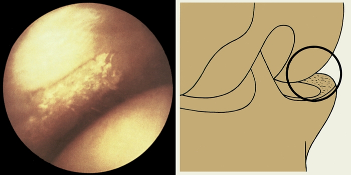 Рис. 2е). Артроскопия менисков - отложение солей кальция во внутреннем мениске при хондрокальцинозе; кружок на схеме коленного сустава соответствует полю зрения артроскопа