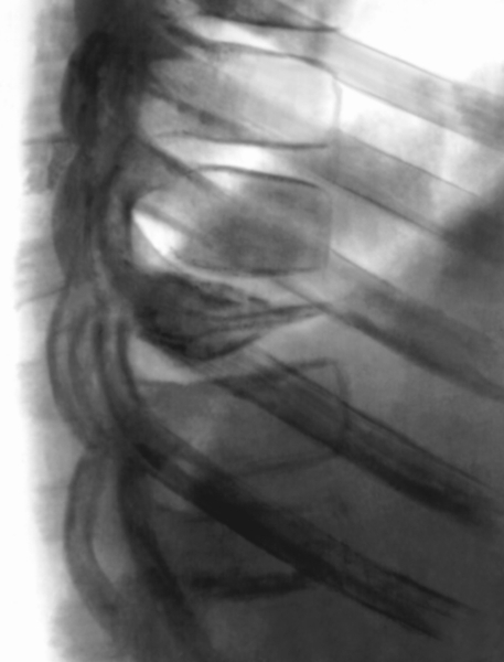 Рентгенограмма грудного отдела позвоночника (боковая проекция): значительное снижение высоты тела пораженного позвонка и неравномерно расширенные межпозвоночные диски