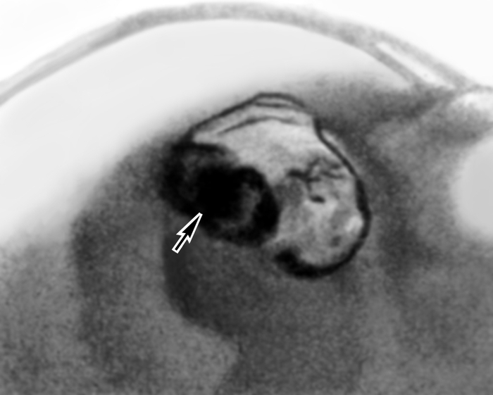 Рис. 4. Латерограмма в положении больного на правом боку при раке желудка: на фоне газового пузыря видна покрытая бариевой взвесью экзофитная <a href=