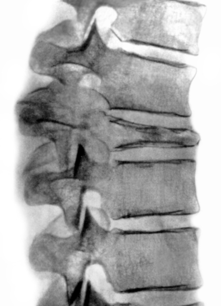 Рис. 16. Рентгенограмма позвоночника (боковая проекция) при деструкции тела позвонка опухолевым процессом