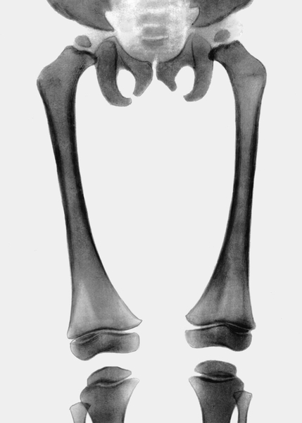 Рис. 25. Рентгенограмма коленных и тазобедренных суставов при множественной эпифизарной дисплазии: поперечник эпифизов бедренной и большеберцовой костей уже, чем ширина метафизарной пластинки