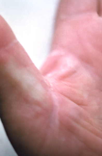 Рис. 3. Аллергический дерматит, вызванный мазью, содержащей хлорамфеникол: разлитая эритема на ладонной поверхности кисти