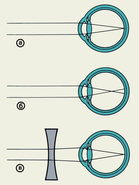 Схематическое изображение хода лучей в эмметропическом (а) и близоруком (б) глазу, а также при использовании корригирующих линз (в)