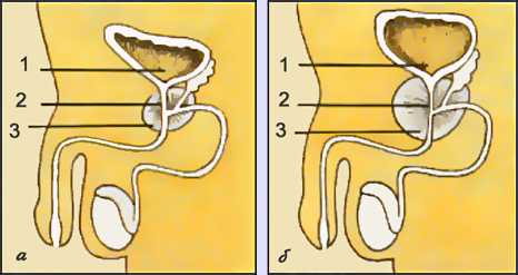 Рис. Аденома предстательной железы. Схематическое изображение органов нижнего отдела мочевыводящей системы мужчины (продольный разрез): а - в норме, б - при аденоме предстательной железы (1 - мочевой пузырь; 2 - простатическая часть мочеиспускательного канала; 3 - предстательная железа)