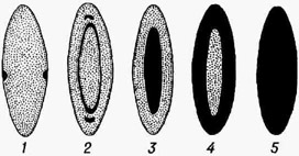 Схематическое изображение различных форм катаракты: 1 - передняя и задняя капсулярные катаракты; 2 - околоядсрная слоистая катаракта; 3 - ядерная катаракта; 4 - корковая катаракта; 5 - полная катаракта