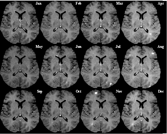 Monthly multiple sclerosis MRI.gif