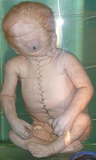 Child with Cyclopia.jpg