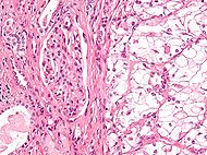 Clear cell renal cell carcinoma high mag cropped.jpg