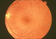 Fundus photograph-normal retina EDA06.JPG