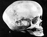 Hydrocephalic skull.jpg