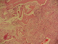Langerhans cell histiocytosis of the bone.jpg