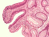Tubular adenoma high mag.jpg