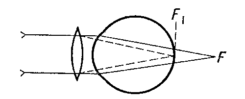 Ход лучей в глазу при дальнозоркости (сплошная линия) и исправление выпуклыми сферическими стеклами —конвексами (пунктир).