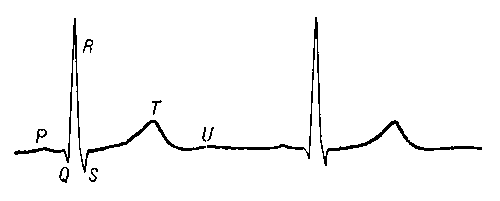 Нормальная кардиограмма.