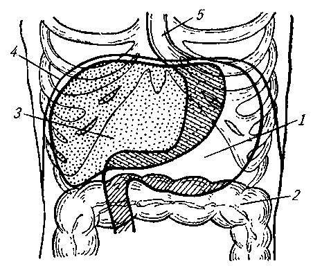 Рис. 5. Схема расположения желудка человека в брюшной полости (заштрихованы части, прикрытые впередилежащими органами): 1 — желудок; 2 — поперечная ободочная кишка; 3 — печень; 4 — диафрагма; 5 — пищевод.