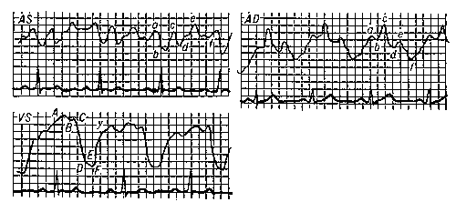 Электрокимограмма здорового человека: AS — левого предсердия; AD — правого предсердия; VS — левого желудочка; латинскими буквами обозначены отдельные элементы кривых.