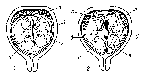 Двойня: 1 — однояйцевая; 2 — двуяйцевая (а — плацента; б — ворсинчатая оболочка; в — водная оболочка).