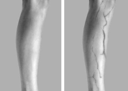 Фотография ноги: слева — в видимом, справа — в инфракрасном излучении; на последней отчетливо видны вены.