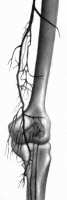 Ангиограмма бедренной артерии.