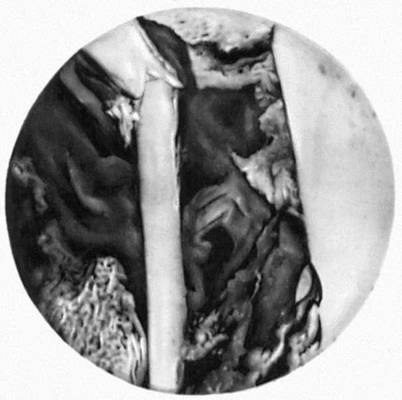 Рис. 4. Рентгеновская микрофотография среза берцовой кости человека в месте перелома (по прошествии 28 дней после перелома). Видно клеточное строение костной ткани — остеоны и остеоциты (белые точки). Увеличено.