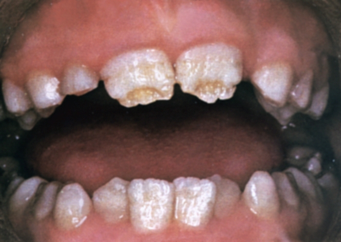 Рис. 6. Зубы при гипоплазии эмали: видны меловидные и желтые пятна, бороздки, деформация коронок зубов