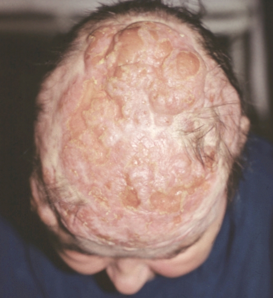 Рис. 2. Опухолевая стадия грибовидного микоза: шаровидные красного цвета опухоли различного размера на волосистой части головы