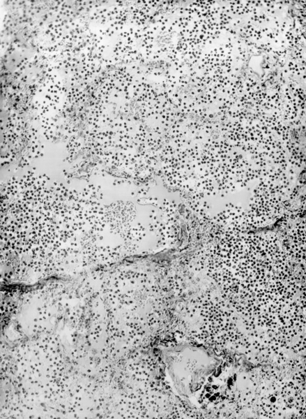 Рис. 1б). Микропрепарат легкого при пневмококковой пневмонии: серозно-лейкоцитарный экссудат в альвеолах; окраска гематоксилином и эозином; ×120