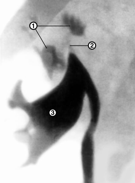 Рис. 8а. Правосторонняя ретроградная пиелограмма при кавернозном туберкулезе правой почки: в верхнем сегменте почки видны заполненные рентгеноконтрастным веществом каверны (1), шейка верхней почечной чашки сужена (2), <a href=