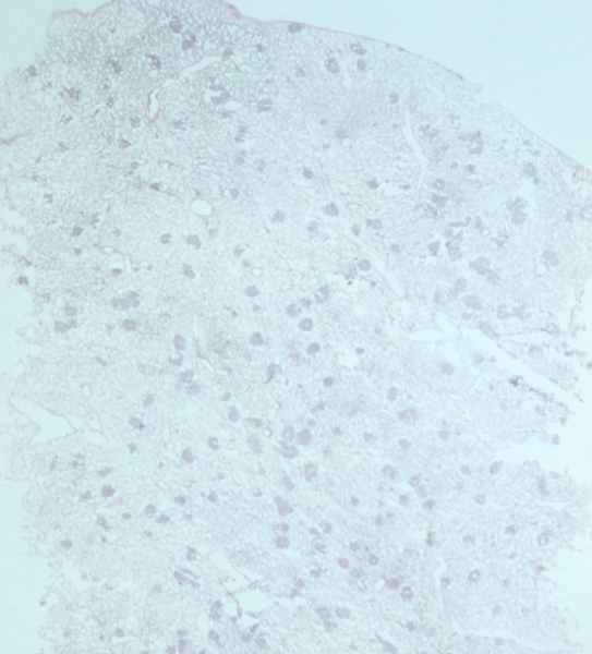 Рис. 4. Гистотопографический срез легкого при остром гематогенно-диссеминированном милиарном туберкулезе: множественные милиарные туберкулезные очаги в легочной ткани; окраска гематоксилином и эозином