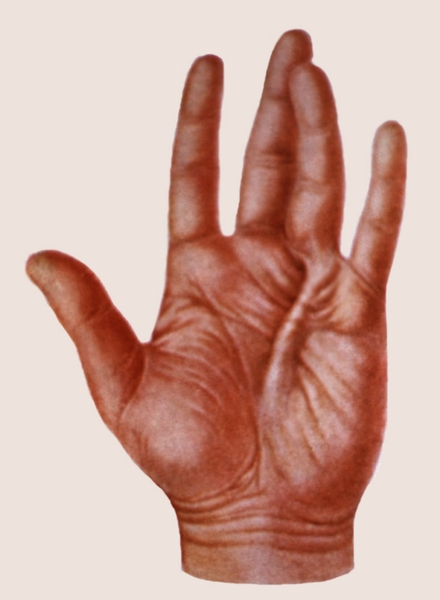 Контрактура Дюпюитрена II степени: формируется сгибательная контрактура суставов IV пальца кисти