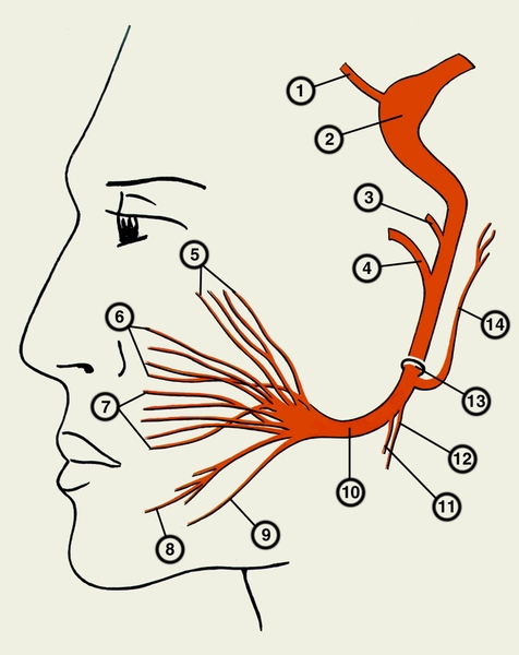 Рис. 5. Схематическое изображение топографии ветвей лицевого нерва: 1 — большой каменистый нерв; 2 — ганглий коленца; 3 — стременной нерв; 4 — барабанная струна; 5 — <a href=