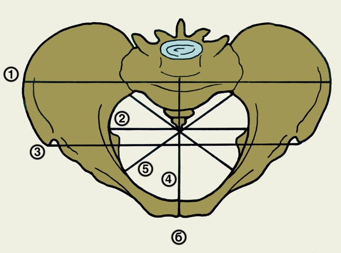 Рис. 2. Основные размеры женского таза: 1 — distantia cristarum; 2 — diameter transversa; 3 — distantia spinarum; 4 — conjugata vera; 5 — diameter obliqua