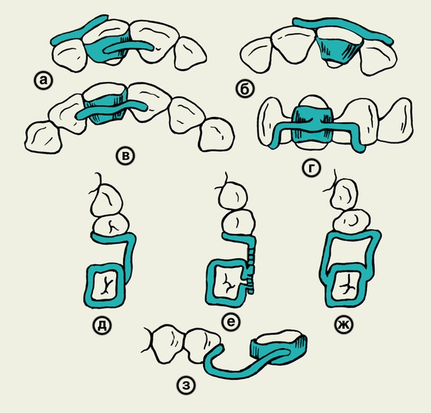 Рис. 15. Схематическое изображение различных видов ретенционных аппаратов: а, б, в, г — аппараты для фиксации зуба после различных видов ортодонтического лечения; д, е, ж, з — аппараты для сохранения промежутков между зубами