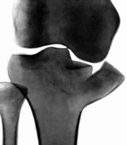 Рис. 23. Рентгенограмма коленного сустава при переломе внутреннего мыщелка большеберцовой кости со смещением