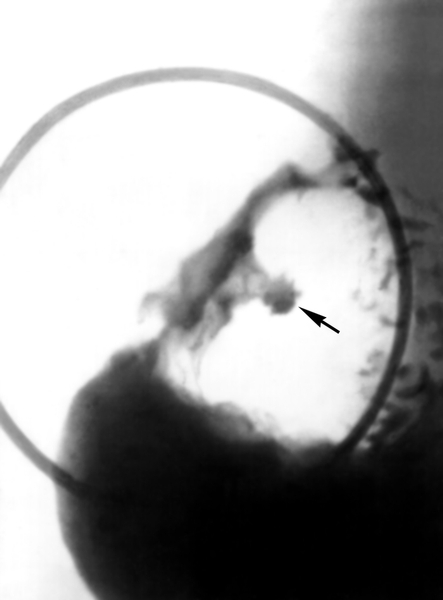 Рис. 1а). Прицельные рентгенограммы (в разных проекциях) луковицы двенадцатиперстной кишки при язвенной болезни: профильная, или контурная, ниша на задней стенке луковицы (указана стрелкой) с воспалительным валом в виде просветления