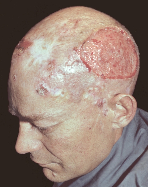 Рис. 1а). Больной базалиомой волосистой части головы — до начала лечения