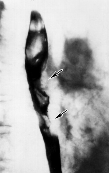 Рис. а). Рентгенологическая картина при различных заболеваниях и поражениях пищевода, сопровождающихся дисфагией: <a href=