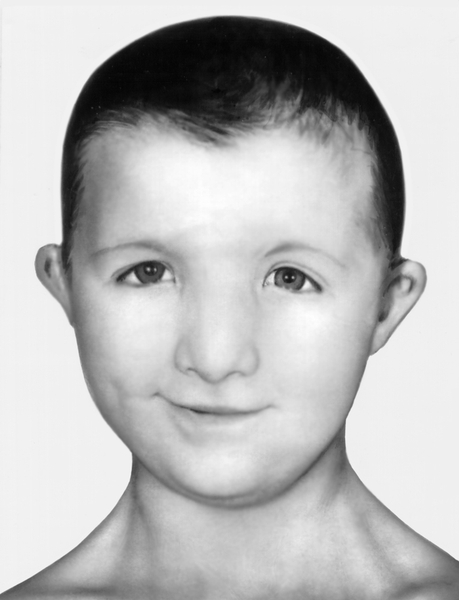 Лицо ребенка с синдромом Нунен: видны характерные для этого заболевания широкая переносица, антимонголоидный разрез глаз, короткая шея