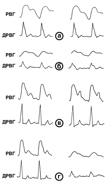 Рис. 3. Реовазограммы (РВГ) и дифференциальные реовазограммы (ДРВГ) предплечья (слева) и кисти (справа) в норме (а) и при разных типах артериальной дистонии: б — спастический тип; в — атонический тип; г — спастико-атонический тип (атонический — на предплечье, спастический — на кисти)