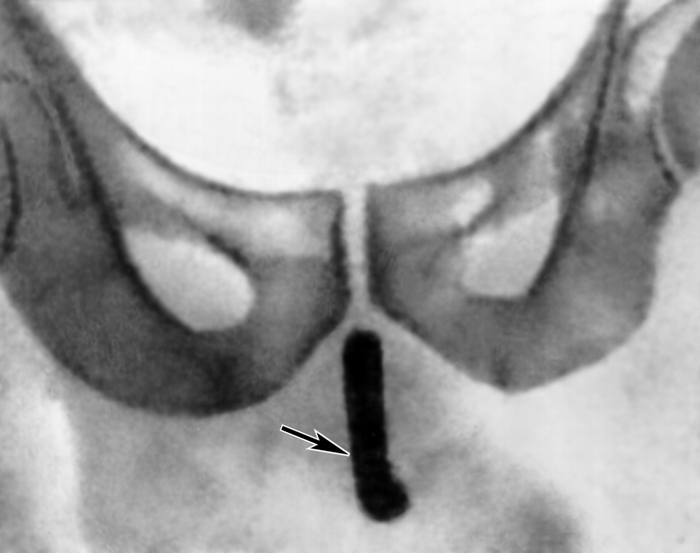 Рис. 3. Обзорная рентгенограмма лобковой области больного с инородным телом в мочеиспускательном канале (часть резинового катетера; тень катетера указана стрелкой)