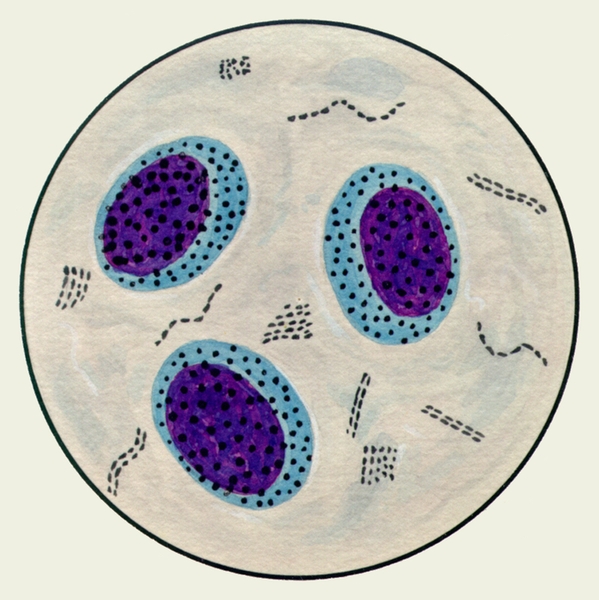 Рис. 3. Микропрепарат мокроты. Альвеолярные макрофаги, содержащие в цитоплазме включения гемосидерина темно-синего цвета; <a href=