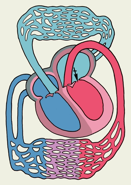 Рис. 8. Схема основных изменений сердца и гемодинамики при митральном стенозе (обозначения те же, что на рис. 3): повышение давления в левом предсердии и в малом круге кровообращения, значительная дилатация и гипертрофия левого предсердия, гипертрофия правого желудочка; перекрещенной стрелкой указано место препятствия продвижению крови (стеноз) в диастолу