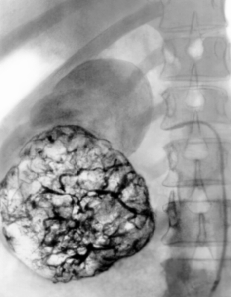 Рис. 17. Селективная почечная ангиограмма рака нижнего полюса правой почки: видна патологически выраженная <a href=