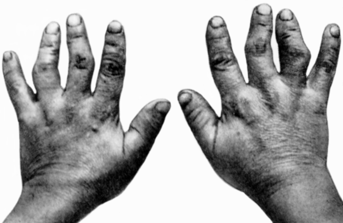 Рис. 1. Укорочение и деформация пальцев при болезни Кашина —Бека