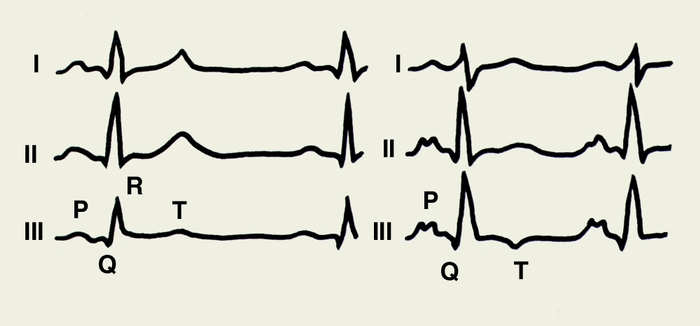 Рис. 2. Электрокардиограммы мужчины 56 лет, страдающего приступами стенокардии в ортостазе, зарегистрированные в трех стандартных отведениях (I, II, III), в положении лежа (слева) и на 8-й минуте пассивной ортостатической нагрузки (справа). Наряду с позиционными изменениями (некоторое отклонение электрической оси сердца вправо) отмечается сглаживание зубцов Т во II отведении и его <a href=
