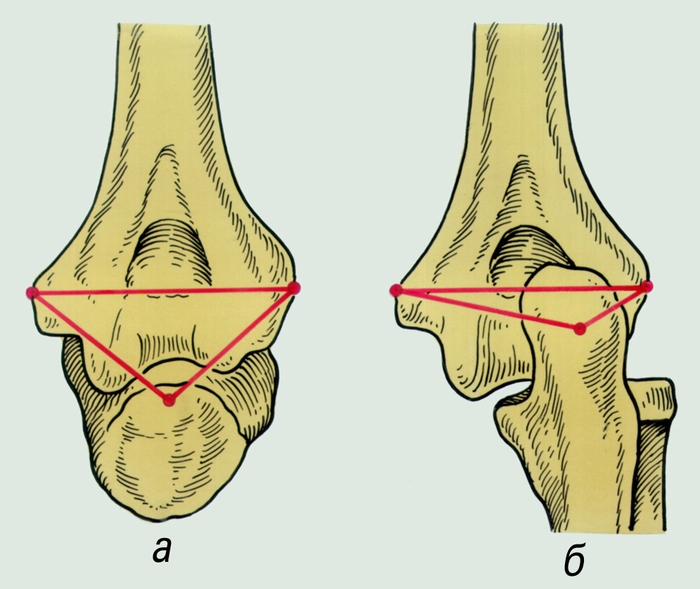 Рис. 1. Взаимоотношение суставных концов костей, образующих локтевой сустав, в норме (а) и при заднем вывихе (б): а — линии, соединяющие надмыщелки плечевой кости и верхушку локтевого отростка, образуют равнобедренный треугольник; б — конфигурация треугольника, образованного теми же костными ориентирами, при заднем вывихе резко изменена