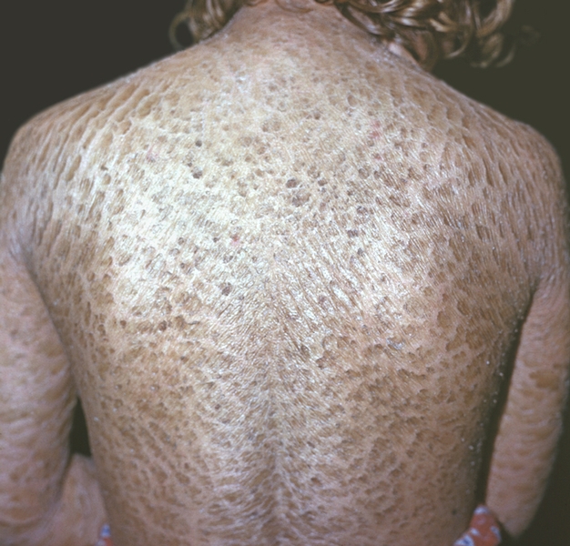 Рис. 4. Проявления ламеллярного ихтиоза: поражение кожи спины и верхних конечностей в виде белесовато-коричневых роговых пластин