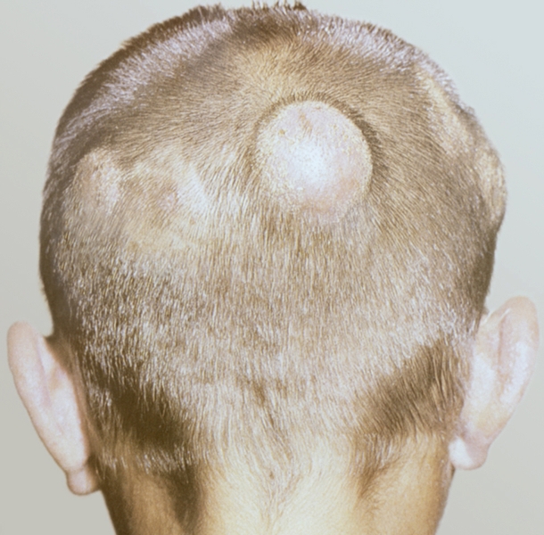 Рис. 5. Округлые резко выступающие над поверхностью кожи очаги на волосистой части головы при инфильтративно-нагноительной трихофитии
