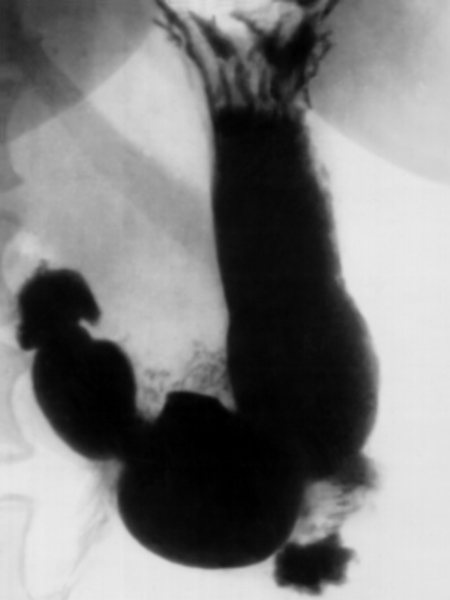 Рис. 3. Рентгенограмма желудка в норме при его тугом наполнении рентгеноконтрастным веществом