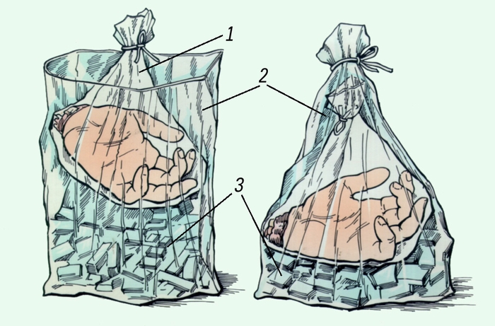 Рис. 2. Схема упаковки ампутированной в результате несчастного случая кисти: 1 — внутренний пакет с ампутированной кистью помещен в наружный пакет (2), заполненный льдом (3)